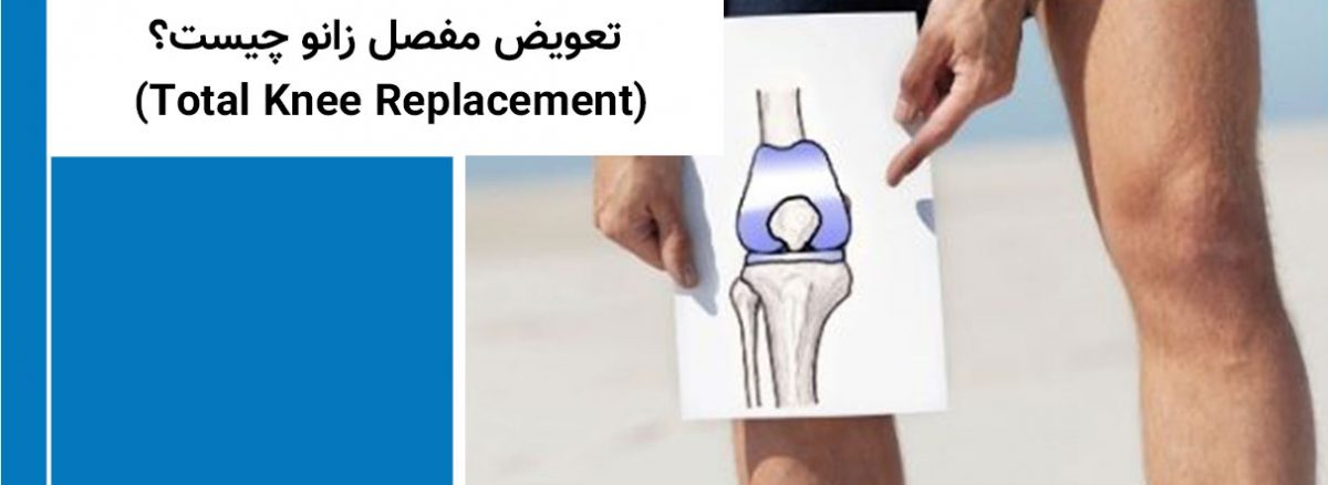  Total Knee Replacement 