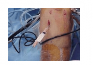 Passage of patellar tendon graft into tibial tunnel of knee